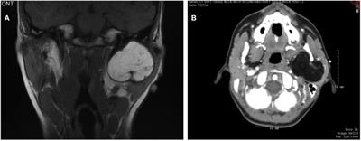 Large Parotid Gland Lipoblastoma in a Teenager